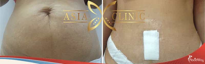 Tummy Tuck Thailand